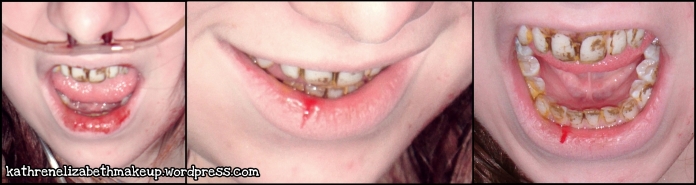 Grimas tooth enamel, Tooth stain